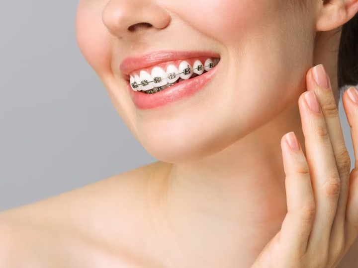 Teeth braces and the advantages of having them on