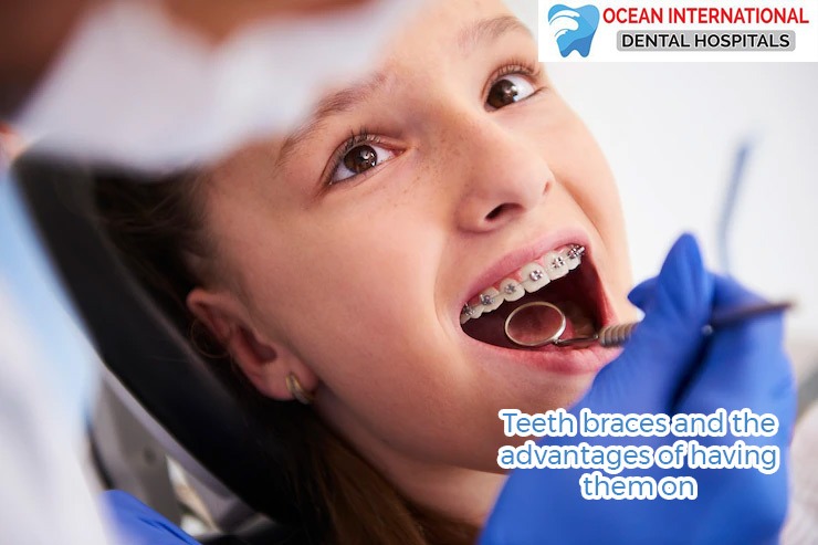 Teeth braces and the advantages of having them on
