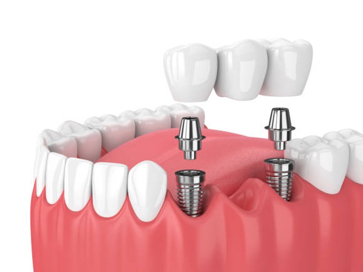 7 Myths about Dental Implants