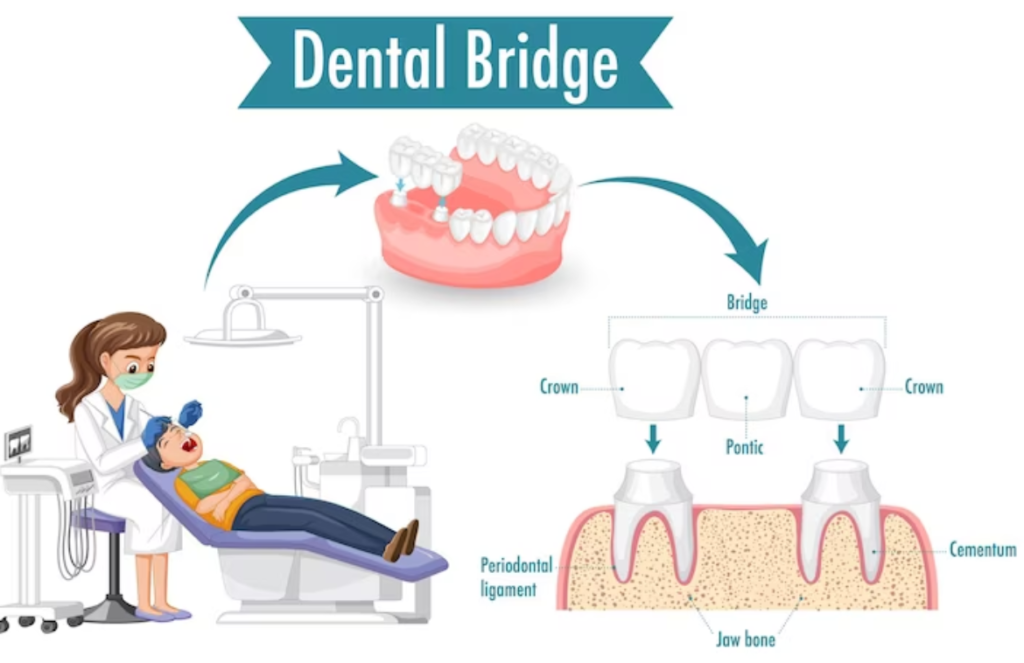 Crown and bridges improve one’s smile and one’s oral health