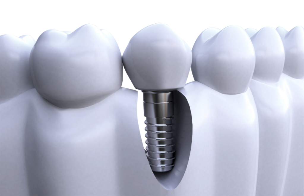 7 Myths about Dental Implants