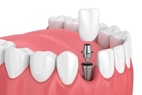 Dental Implants left image