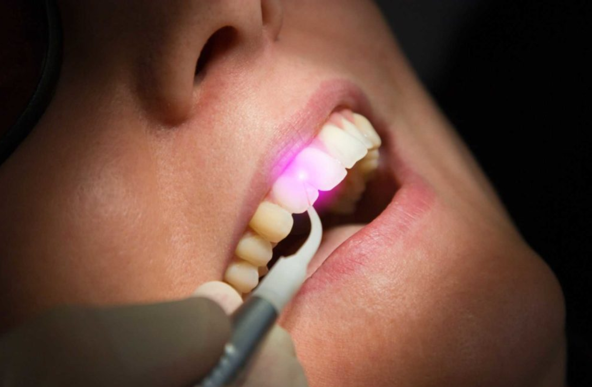 What is laser RCT and its benefits? 