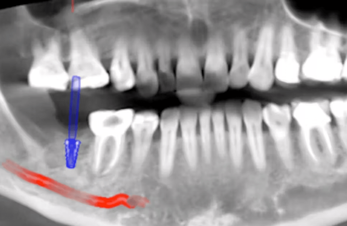 CBCT vs Traditional X-rays: Advantages and Disadvantages