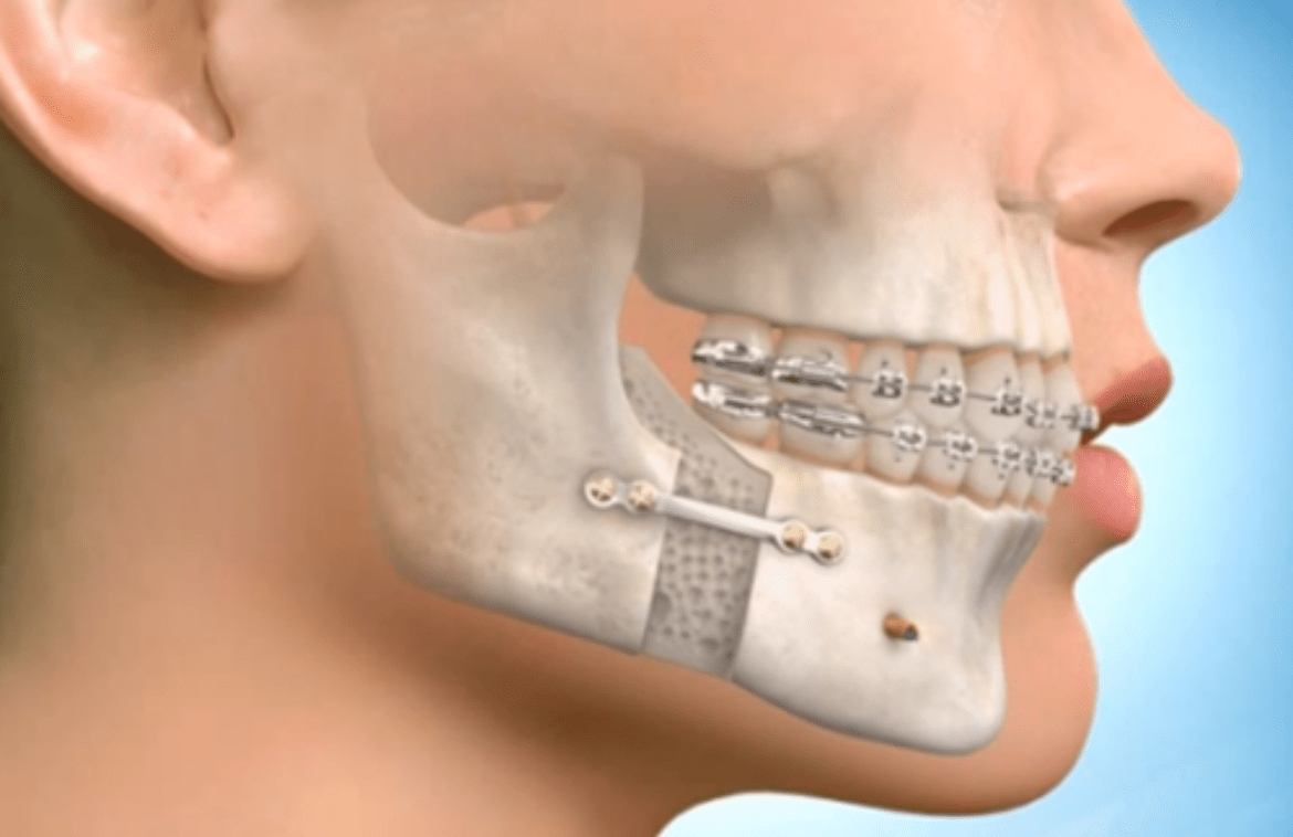 Common Orthognathic Surgery Myths and Misconceptions