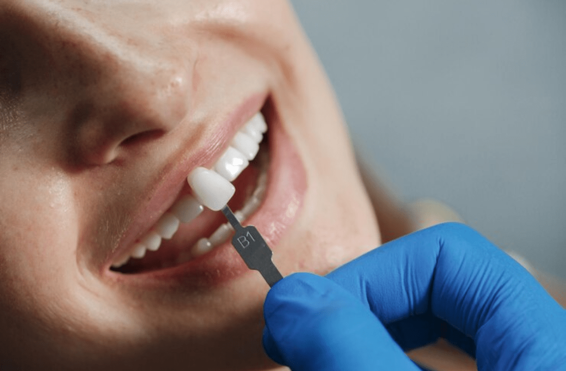 Cosmetic dentistry: what is it? Procedures and Types