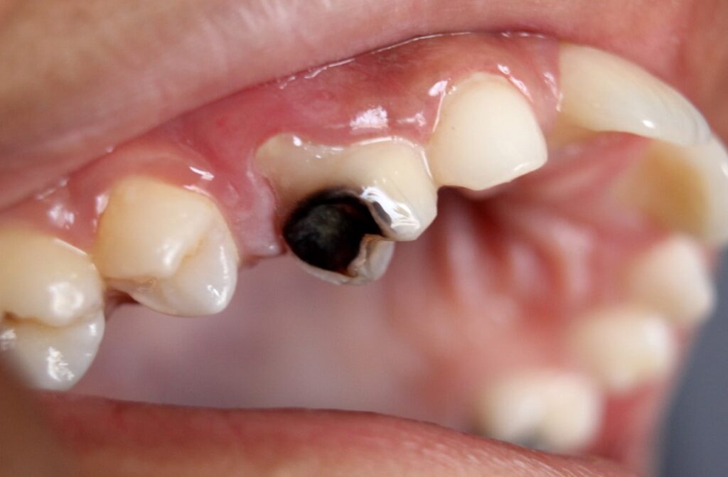 Common Tooth Decay Causes You Might Be Ignoring