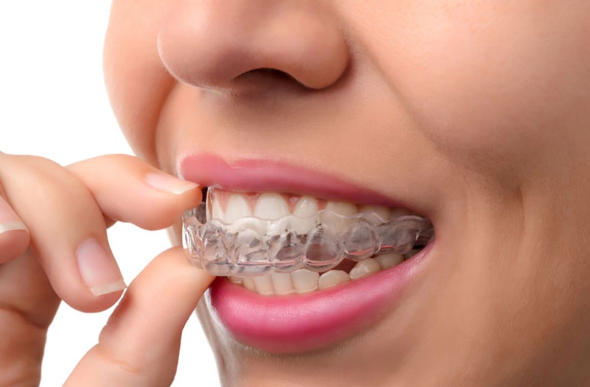 The Role of Digital Scanning in Invisalign Treatment