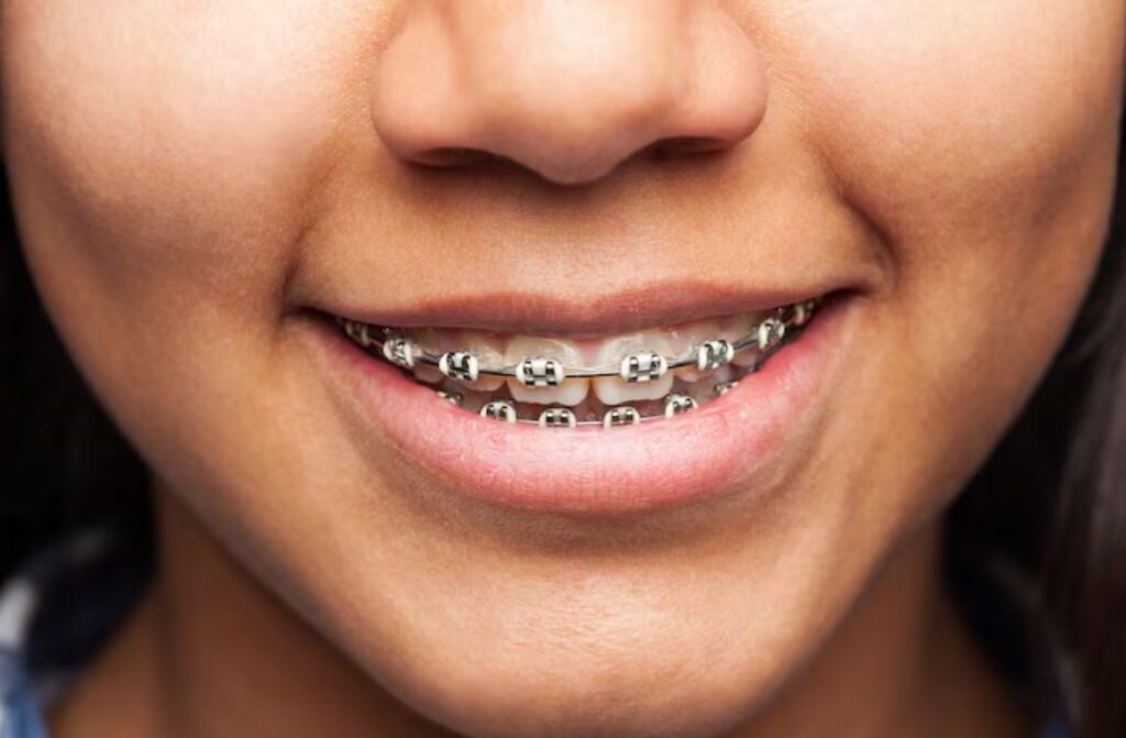 Understanding Differences between Types of Dental Braces