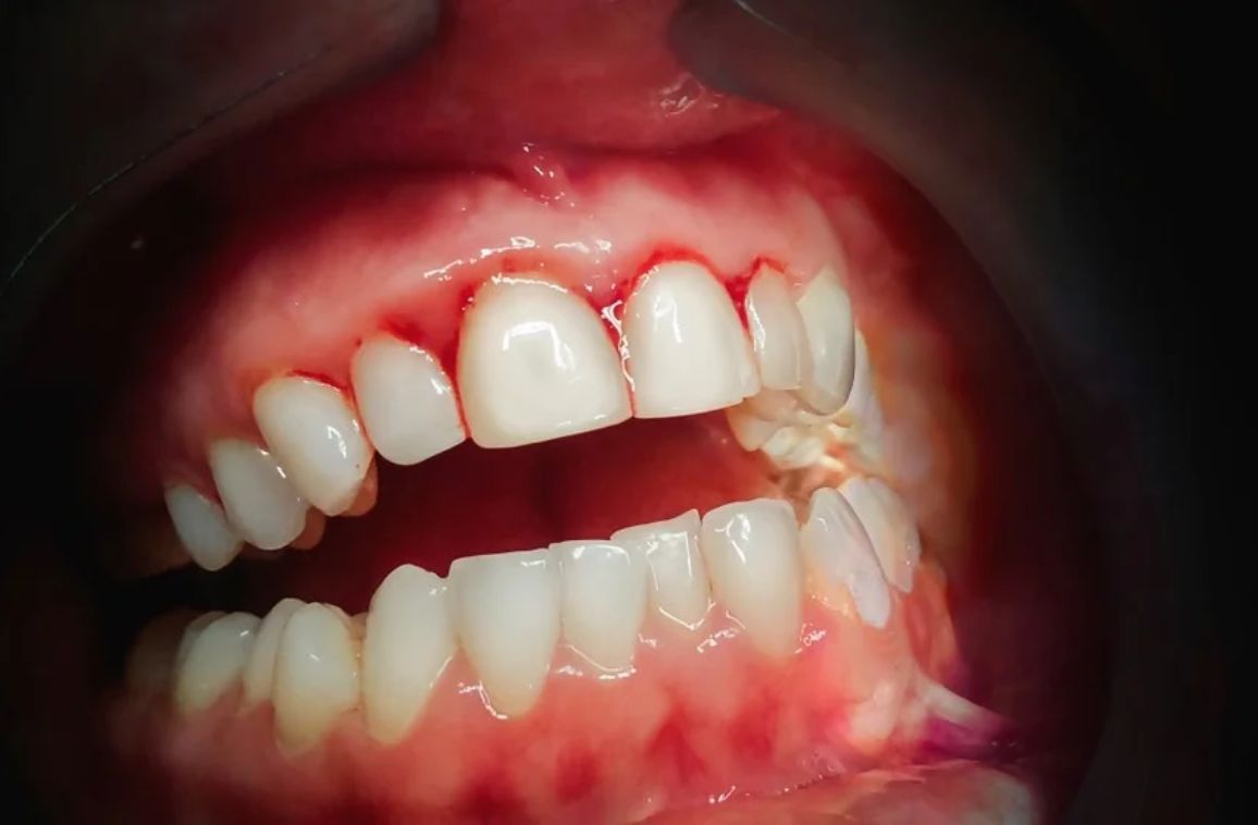 Bleeding gums causes and treatment for healthy teeth