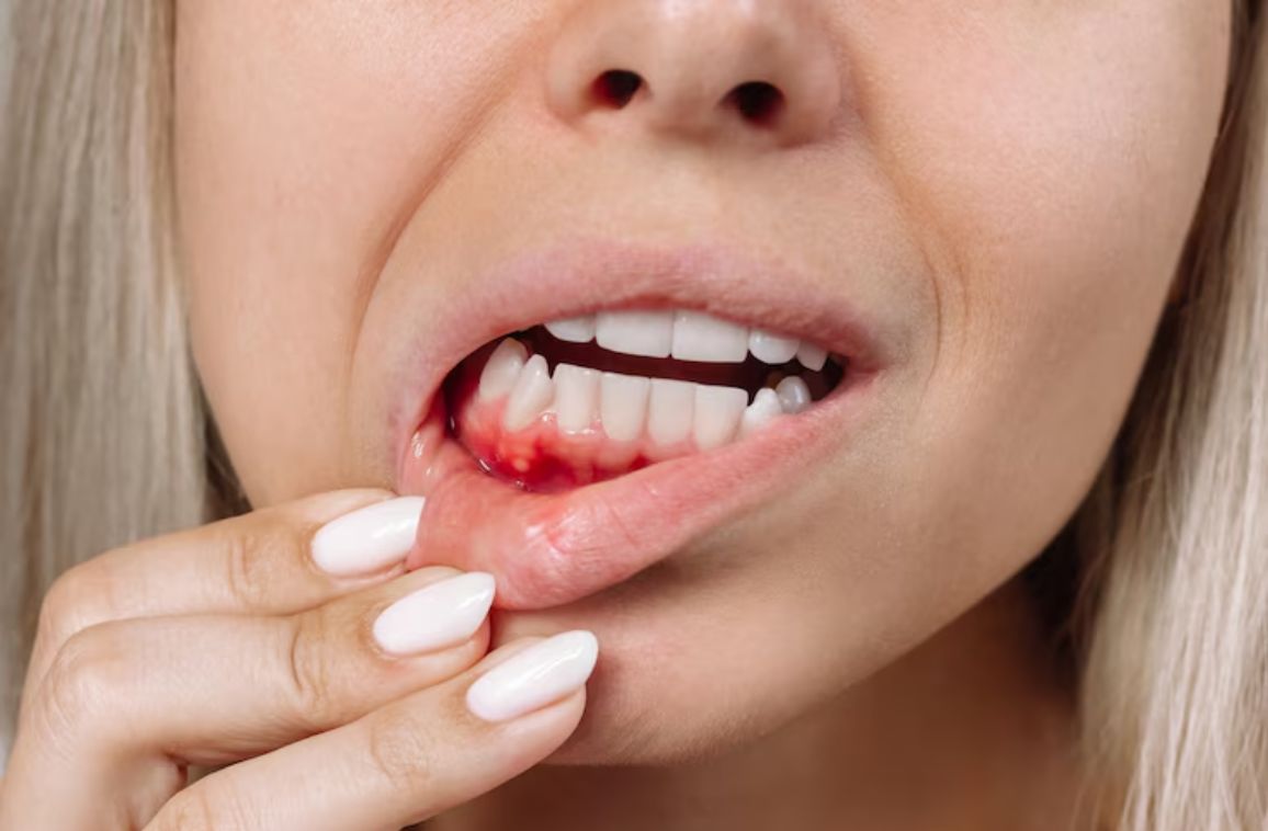 Bleeding gums causes and treatment for healthy teeth