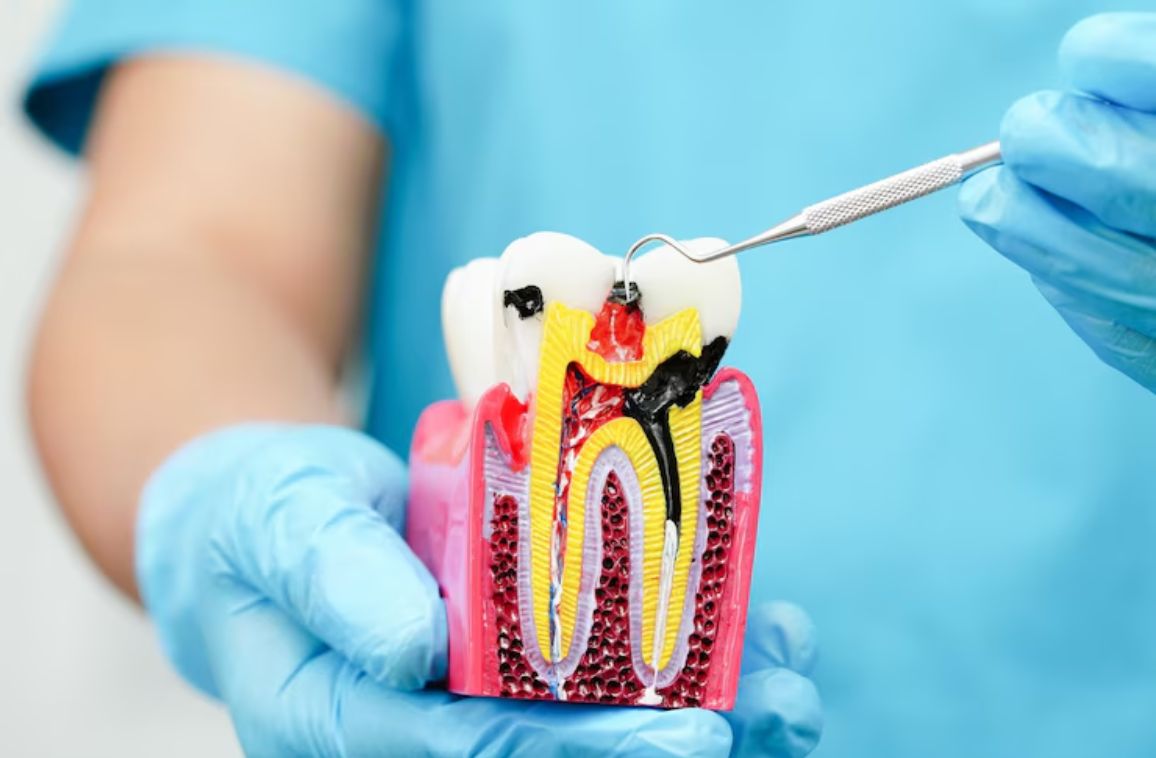 How much does root canal treatment cost in Hyderabad?