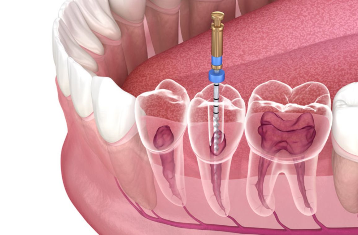 How much does root canal treatment cost in Hyderabad?