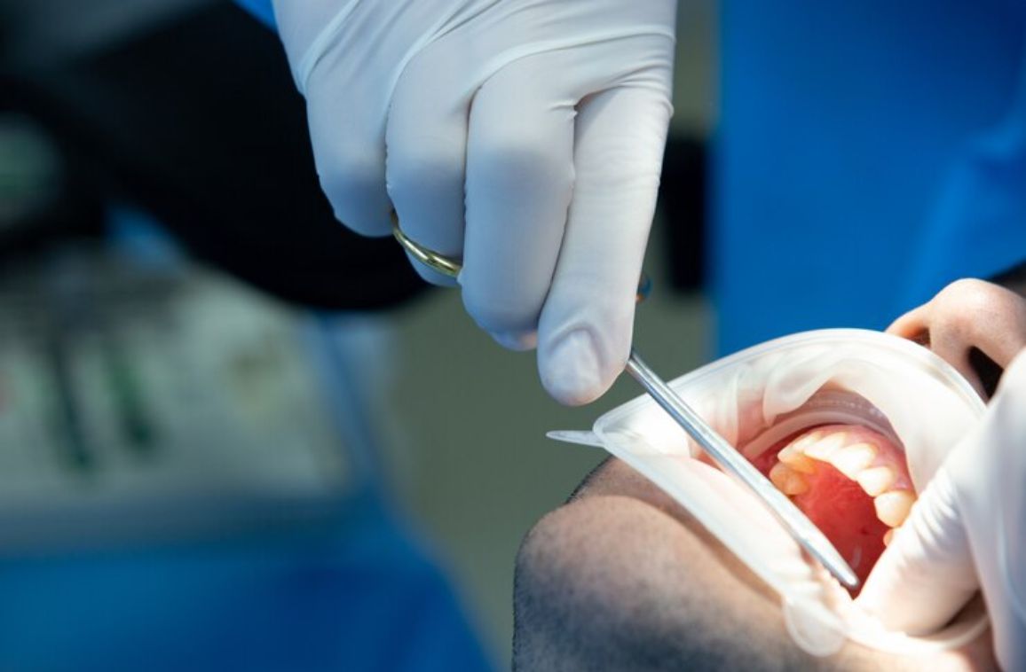 Bone Grafting for Teeth When and Why it’s Needed?