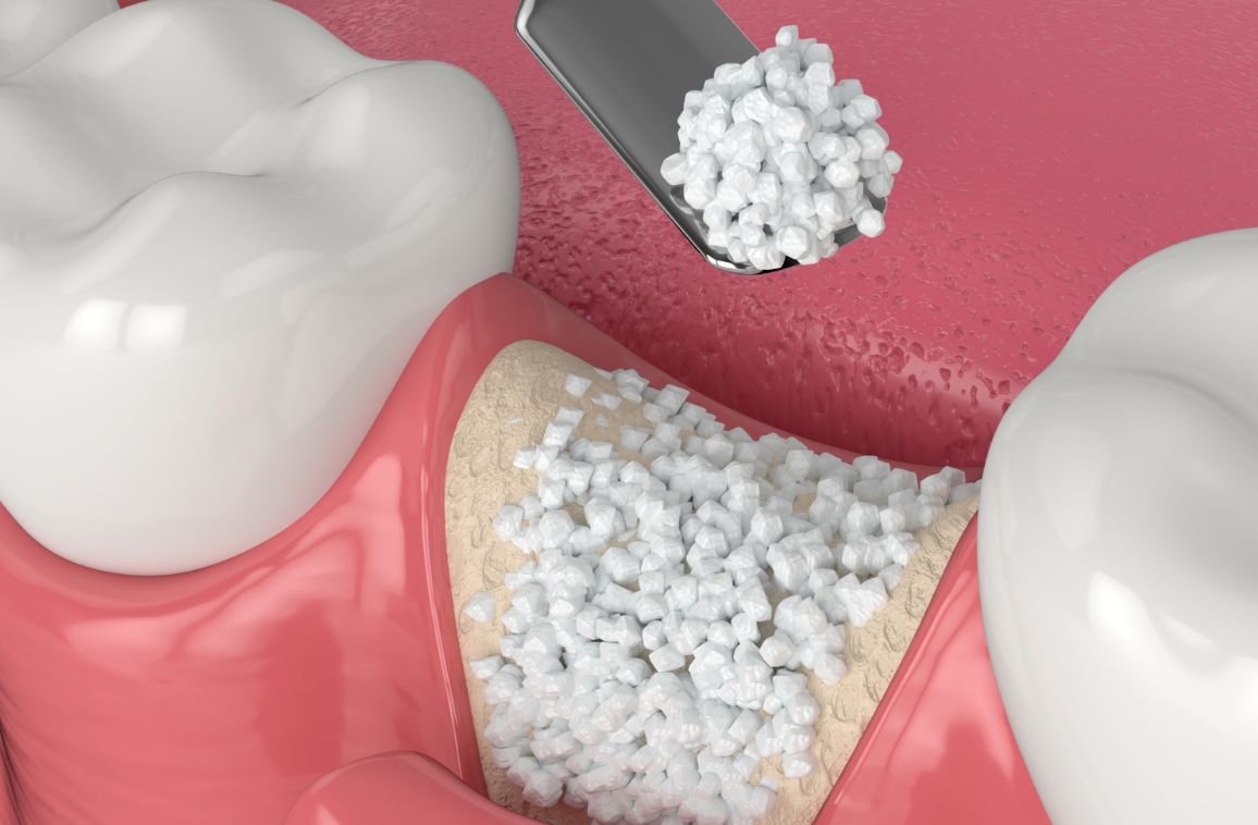 Bone Grafting for Teeth When and Why it’s Needed?