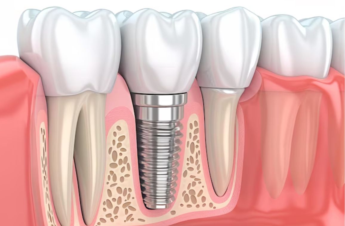 Dental Implants Changing Oral Health