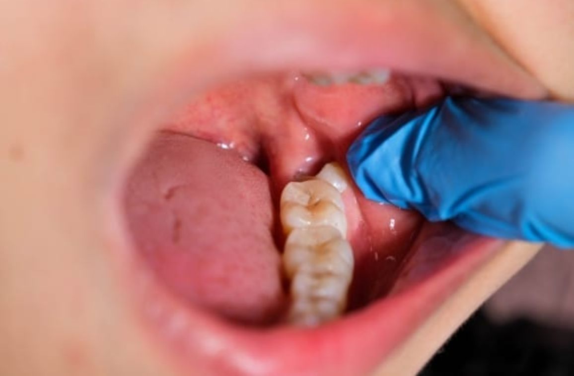 Wisdom Teeth Pain: When to See a Dentist