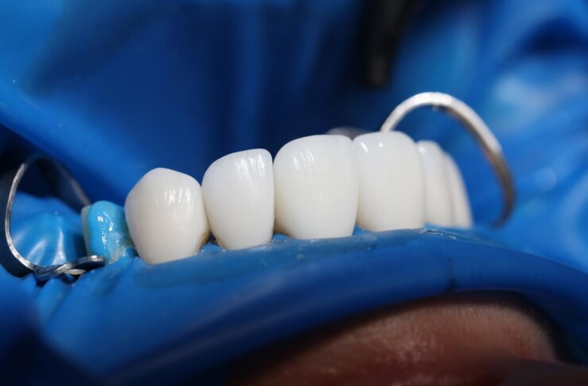 Smile Design Treatment: What to Expect and How It Works