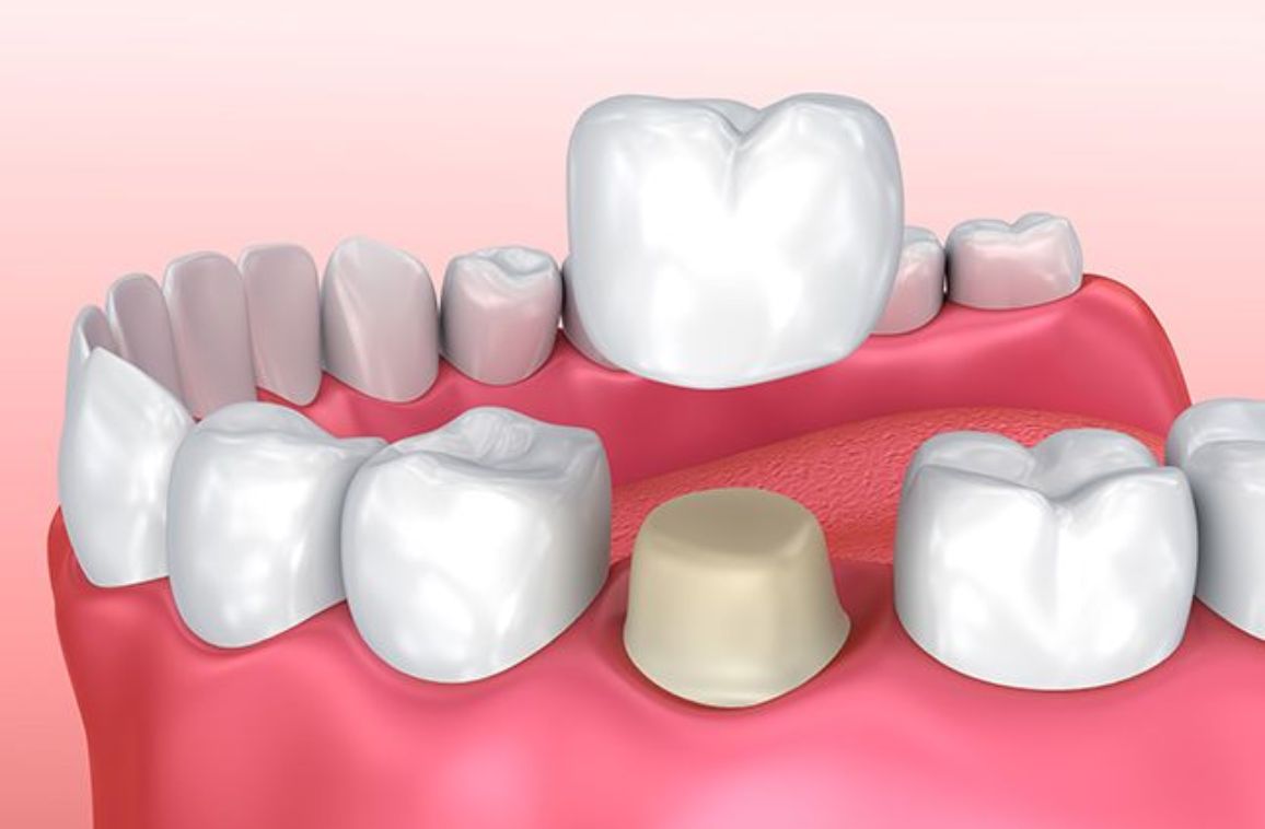 Dental Implants Procedure: Before, During, and After Care