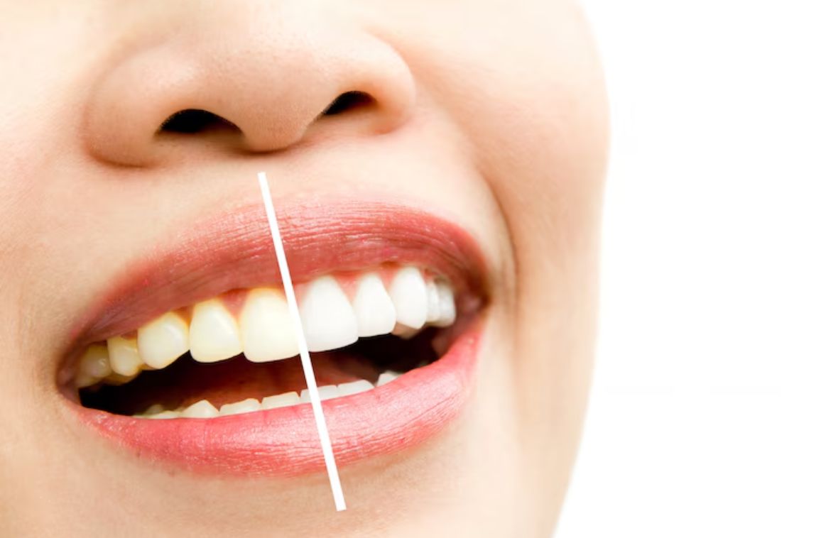 Teeth Whitening Treatments: Choose Option Right for Oneself