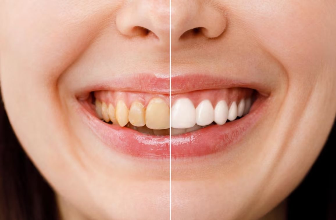 Teeth Whitening: Pros, Cons, and Procedures