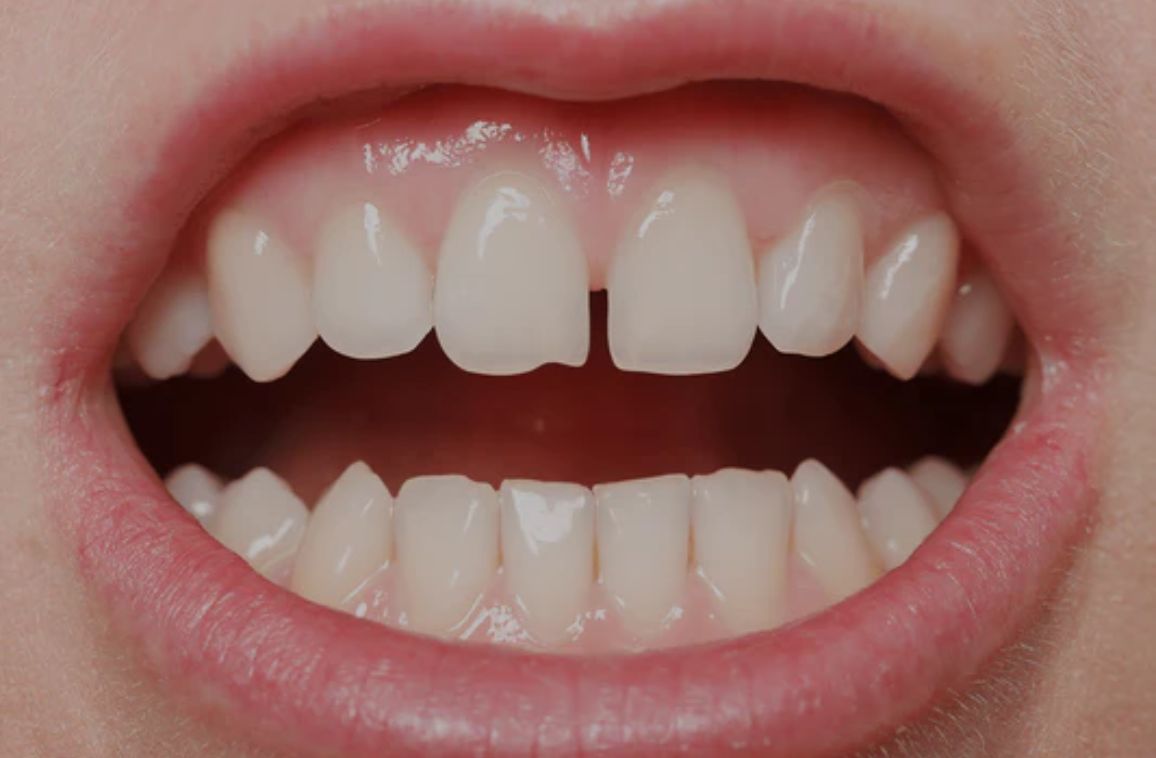 How to Fix Gaps in Teeth: Cosmetic and Orthodontic Solutions