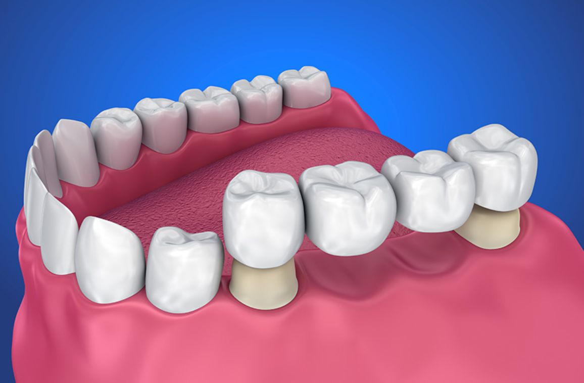 Smile Makeover: Popular Cosmetic Dental Procedures