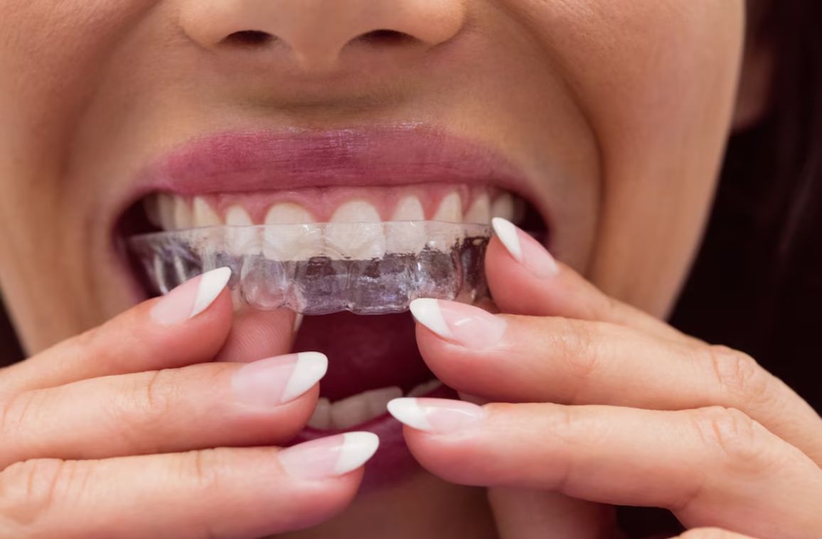 Invisalign Benefits: How Clear Aligners Transform One’s Smile